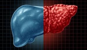 Fatty Liver Disease Is No Longer Reserved for Older Adults